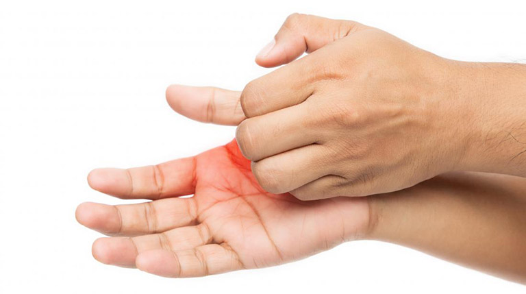 Các bệnh viêm da tự miễn là nguyên nhân hàng đầu khiến da tay bị khô